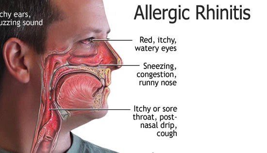 Homeopathic Treatment for Allergic Rhinitis: A Holistic Approach