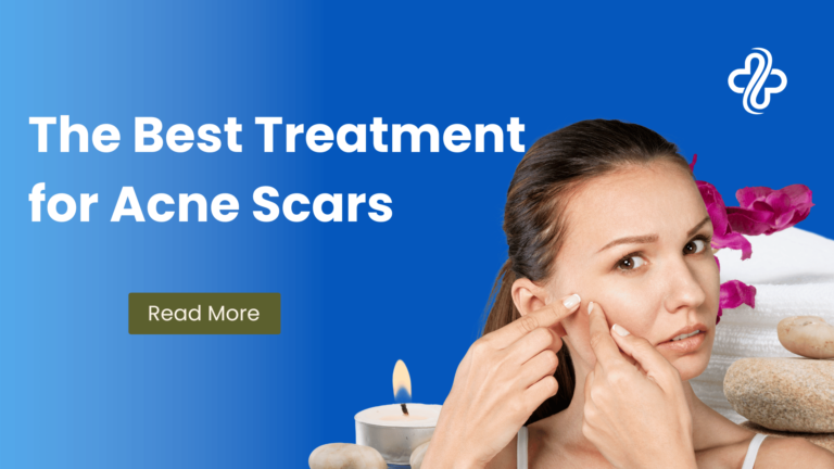 Acne Scars