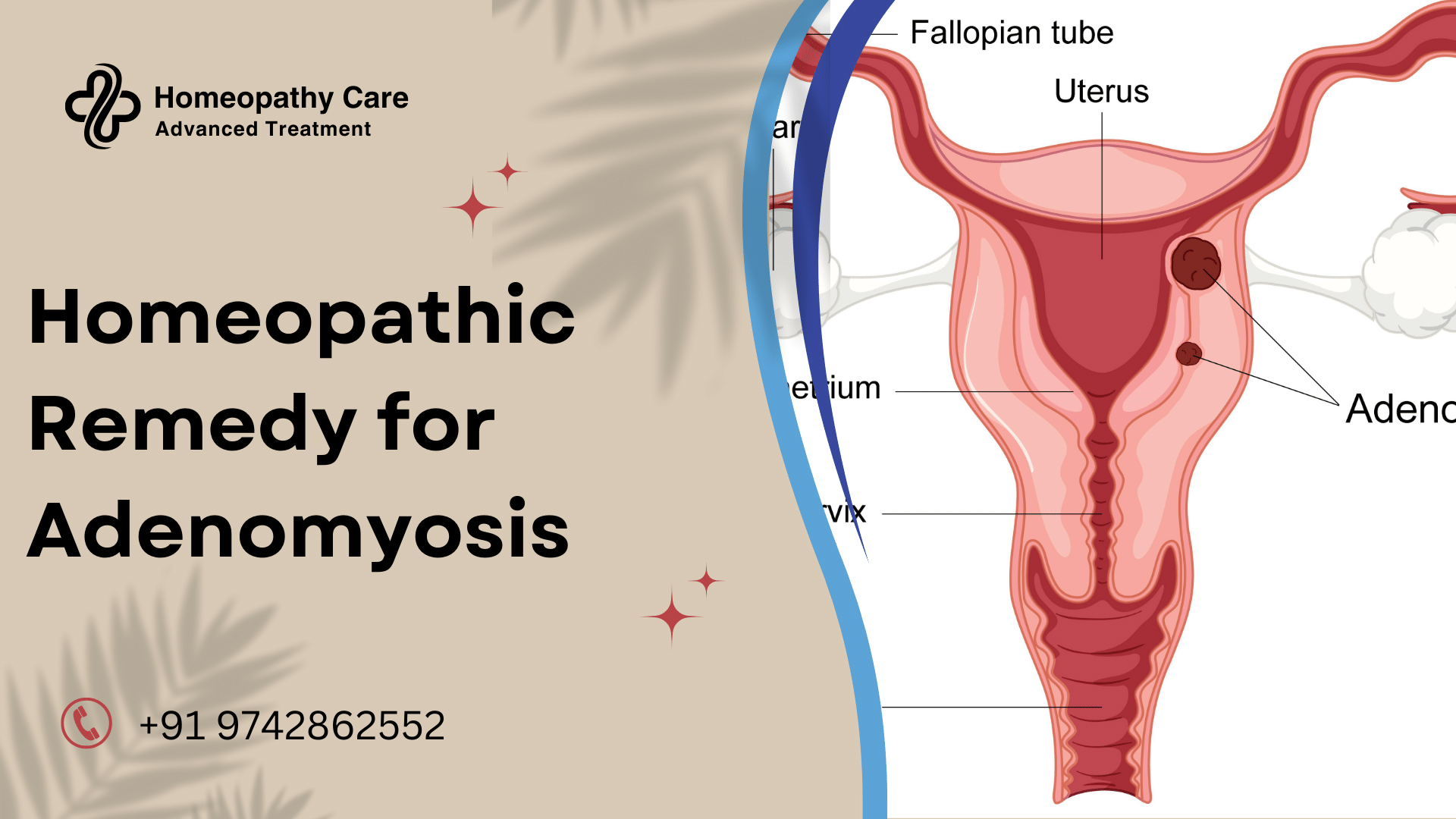 Homeopathic Remedy for Adenomyosis