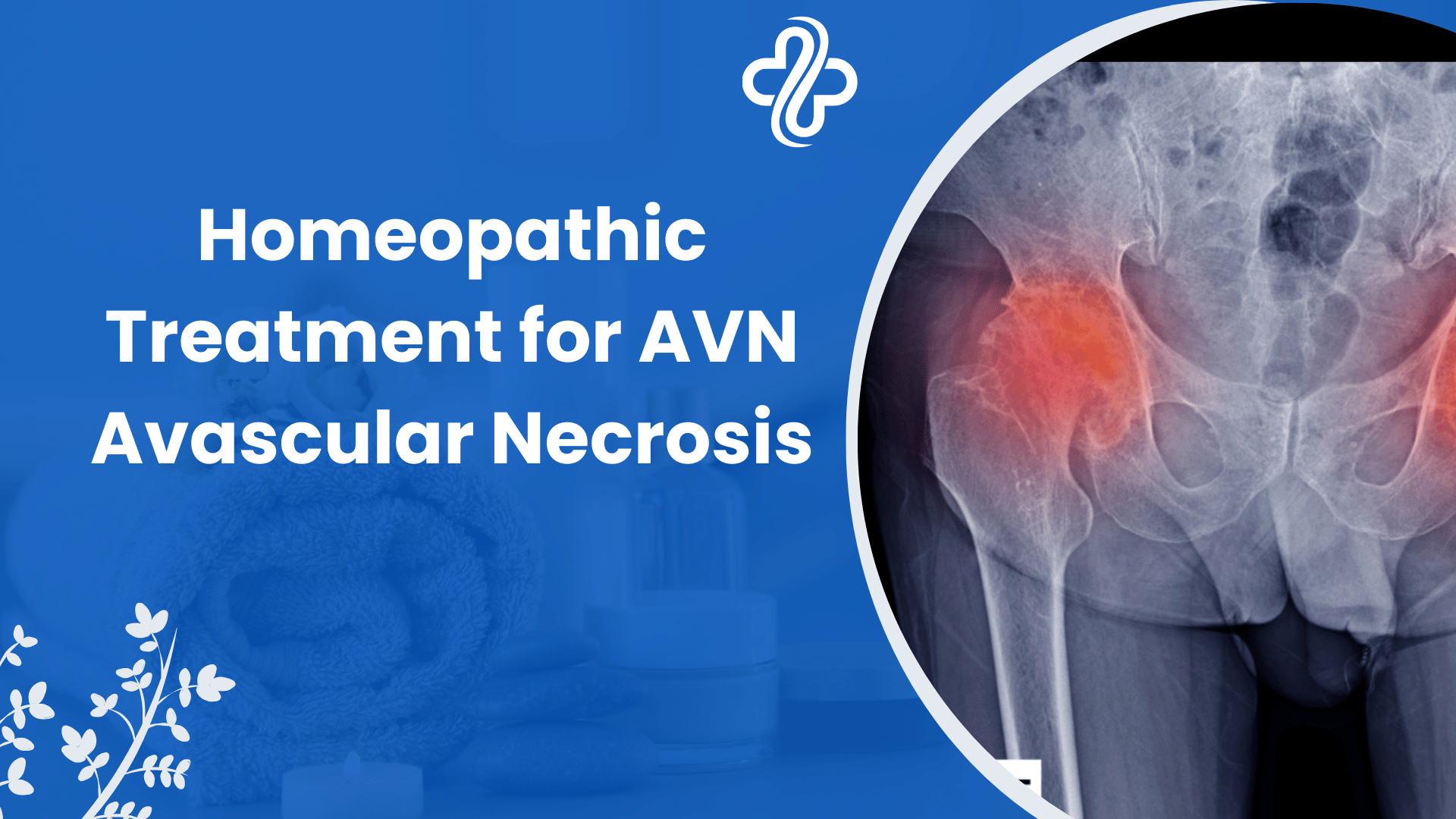 Homeopathic Treatment for AVN Avascular Necrosis