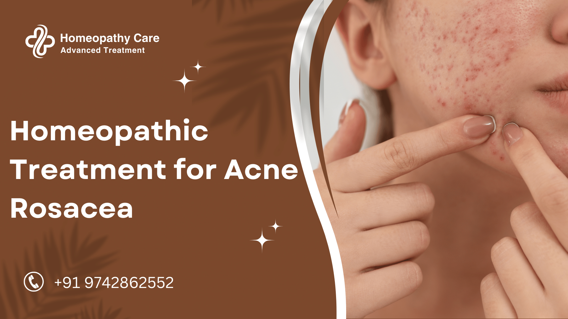 Homeopathic Treatment for Acne Rosacea