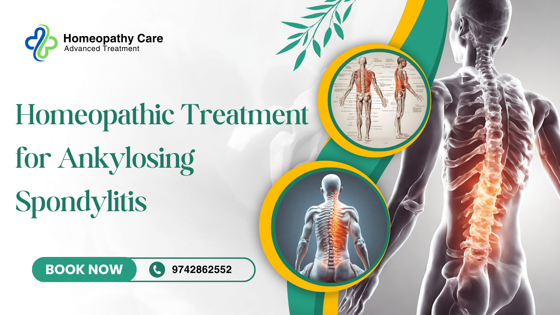 Homeopathic Treatment for Ankylosing Spondylitis