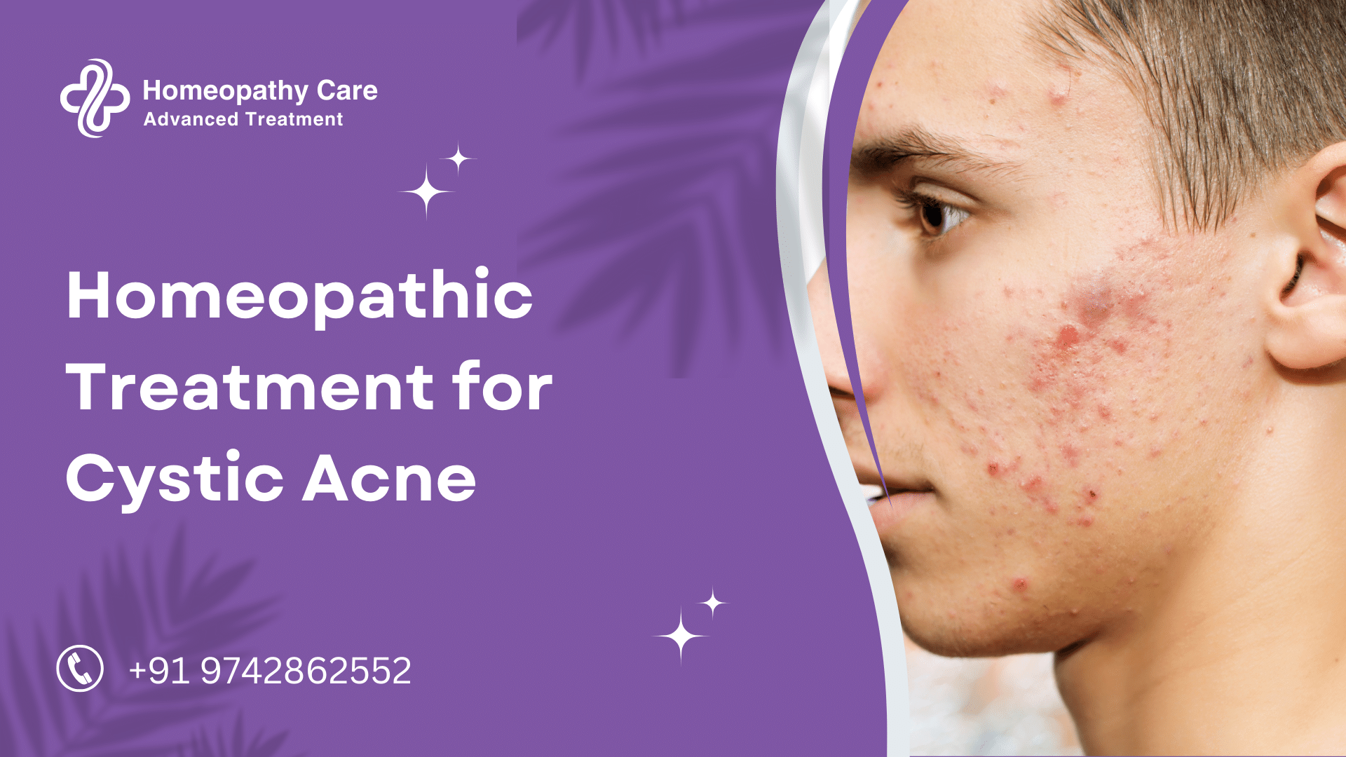 Homeopathic Treatment for Cystic Acne