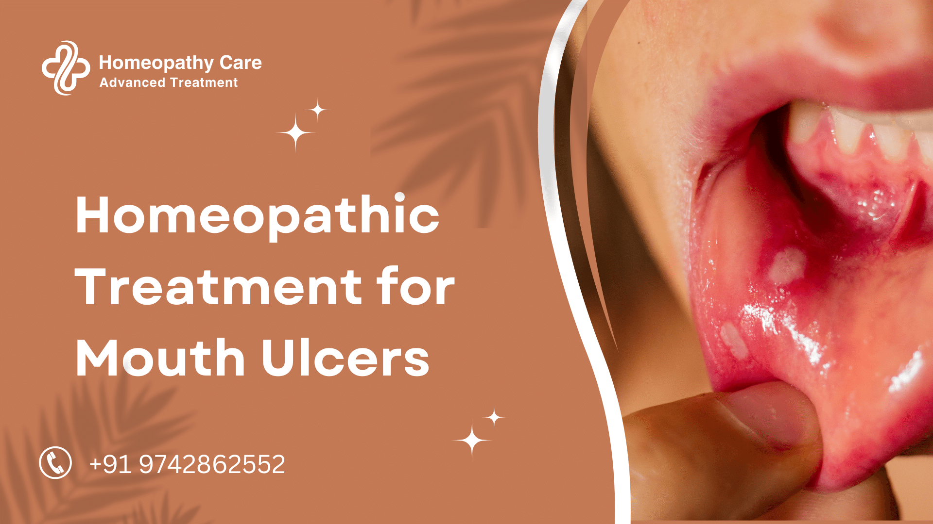 Homeopathic Treatment for Mouth Ulcers