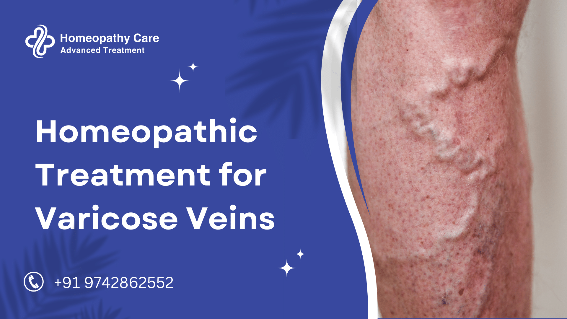 Homeopathic Treatment for Varicose Veins (1)