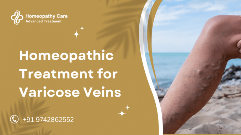 Homeopathic Treatment for Varicose Veins