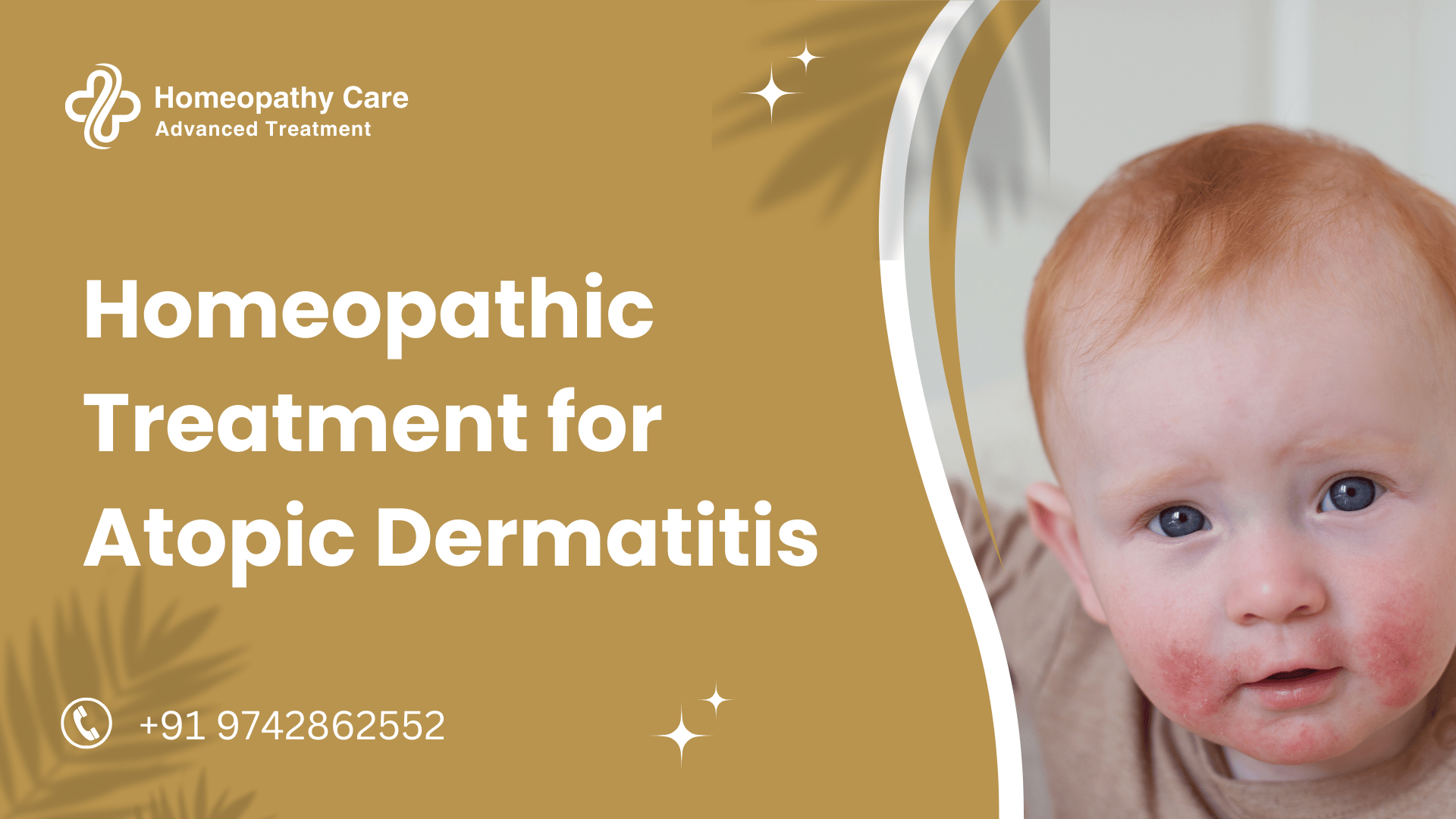 Homeopathic Treatment for Atopic Dermatitis