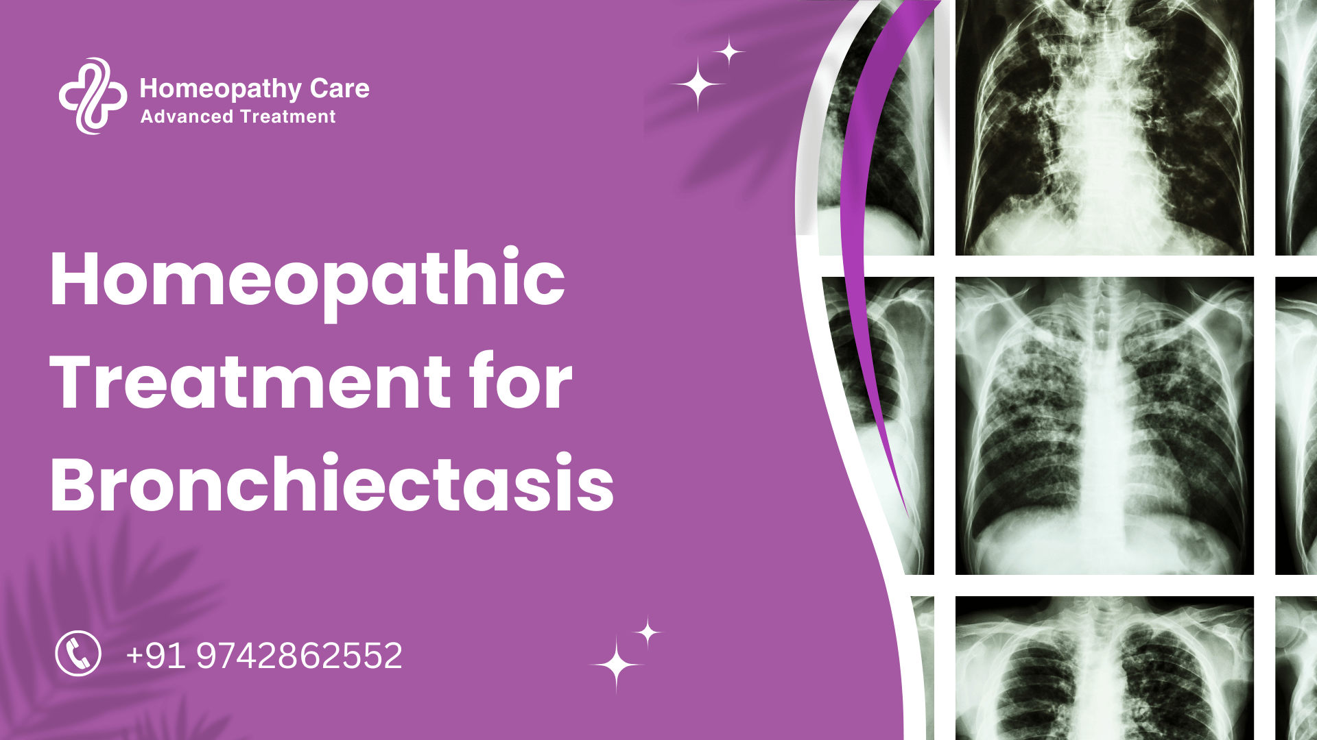 Homeopathic Treatment for Bronchiectasis