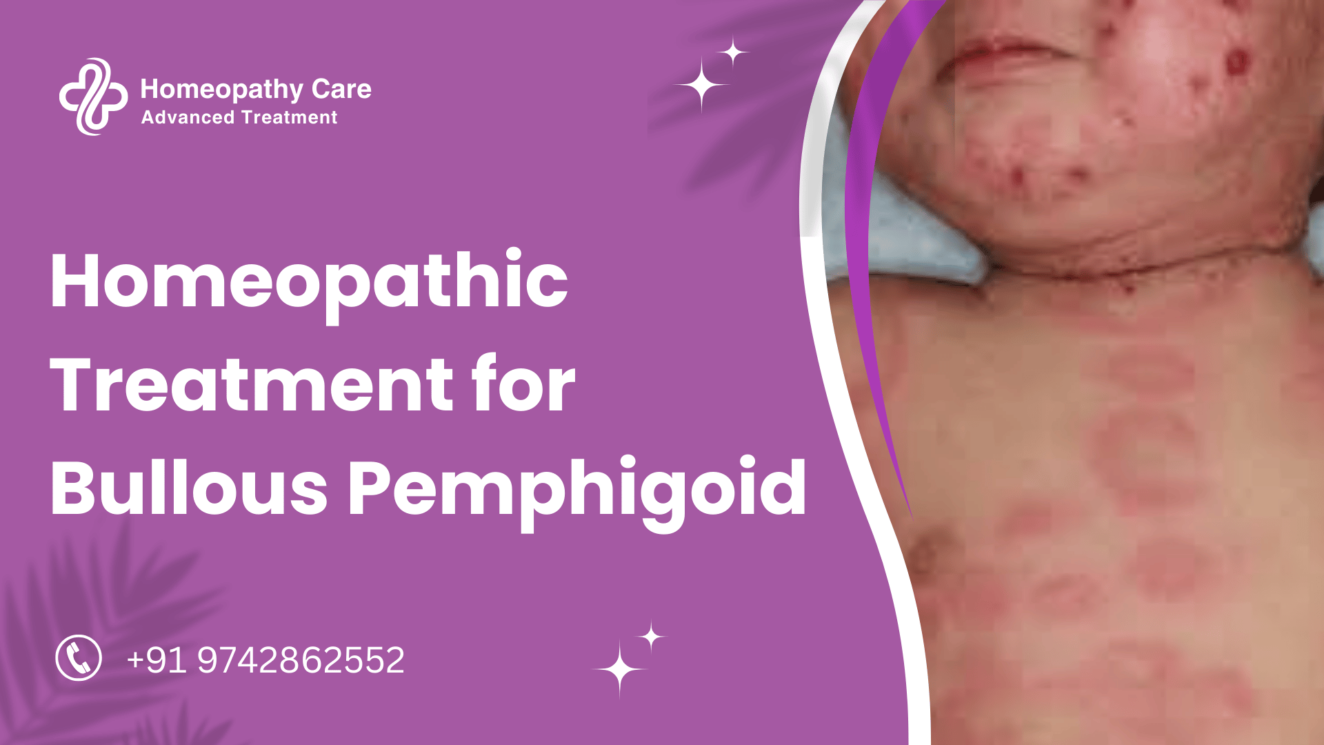 Homeopathic Treatment for Bullous Pemphigoid