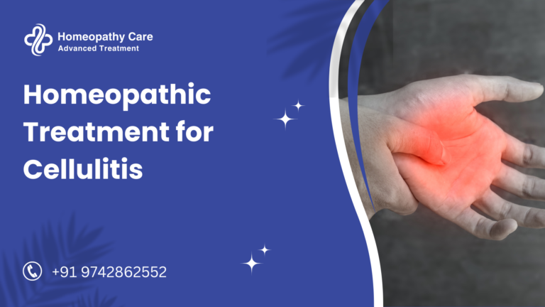 Homeopathic Treatment for Cellulitis